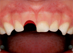 avulsion_-primary-teeth
