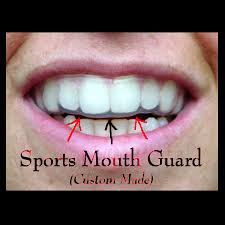mouth-guard